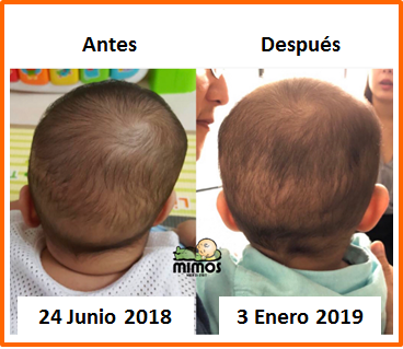 Cojin Mimos Mexico - La plagiocefalia o cabeza plana por posición se puede  corregir si se atiende oportunamente. Les compartimos esta maravillosa  historia de este bebé 👶 que empezó su tratamiento con