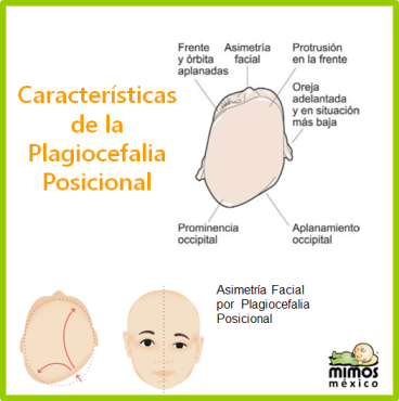 caracteristicasdelaplagiocefaliaposicionalWP